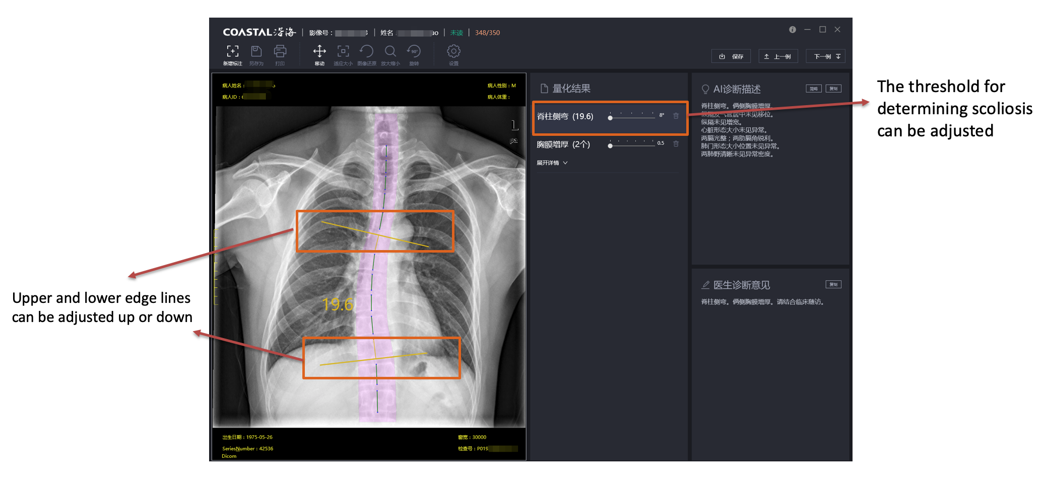 脊柱侧弯结果展示